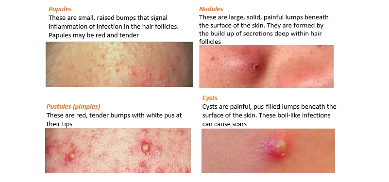 Examples of inflammatory lesions on the skin (Acne and Pimples)